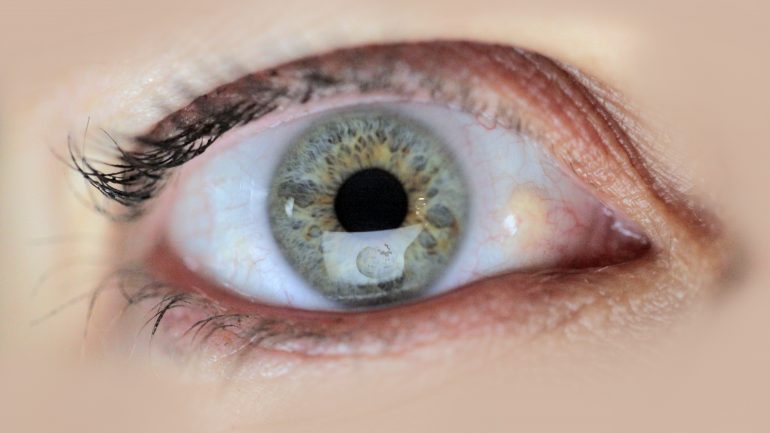 oeil ophtalmologie